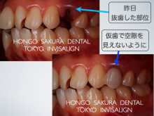 インビザライン　治療　ブログ-東京都　歯科　矯正　インビザライン