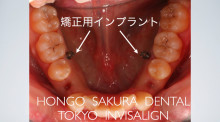 $インビザライン　治療　ブログ-東京都　歯科　矯正　インビザライン